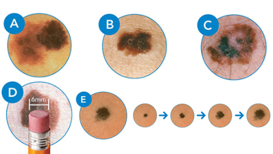 Unveiling Skin's Secrets: A Comprehensive Guide to Dermoscopic Features – Unlocking Early Detection's Key Code