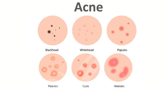 Can Dermatoscope Detect Acne?