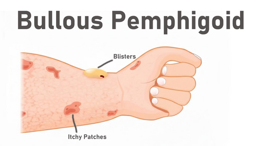 Can Dermatoscope Detect Bullous Pemphigoid?