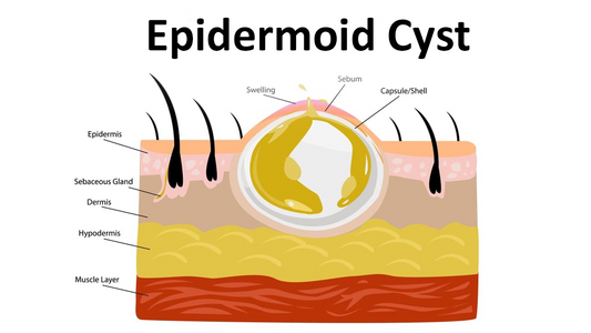 Can Dermatoscope Detect Epidermoid Cyst?