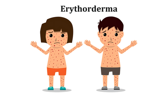 Can Dermatoscope Detect Erythroderma?