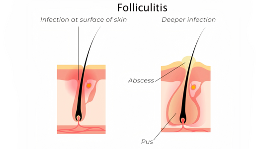 Can Dermatoscope Detect Folliculitis?