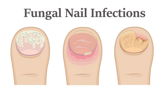 Can Dermatoscope Detect Fungal Nail Infection?