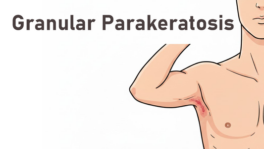 Can Dermatoscope Detect Granular Parakeratosis?