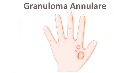 Can Dermatoscope Detect Granuloma Annulare?