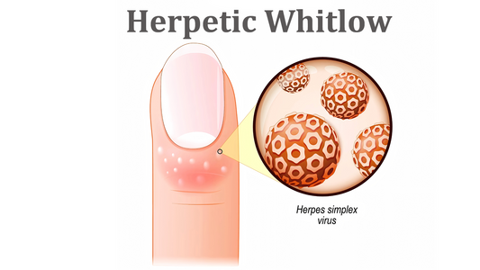 Can Dermatoscope Detect Herpetic Whitlow?