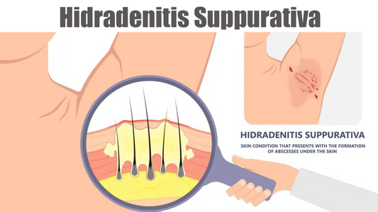 Can Dermatoscope Detect Hidradenitis Suppurativa?