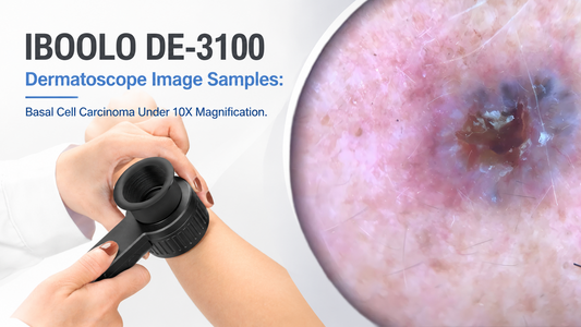 IBOOLO DE-3100 Dermatoscope Image Samples: Basal Cell Carcinoma  Under 10X Magnification