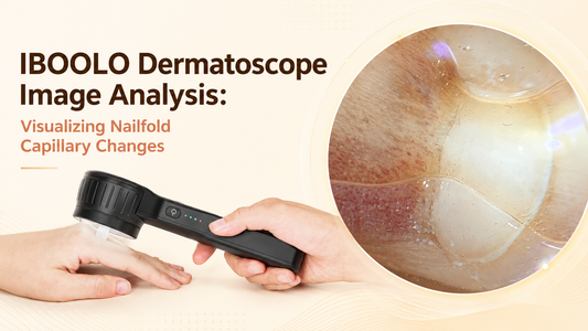 Nailfold Capillary under IBOOLO DE-4100 dermatoscope