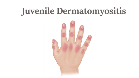 Can Dermatoscope Detect Juvenile Dermatomyositis?