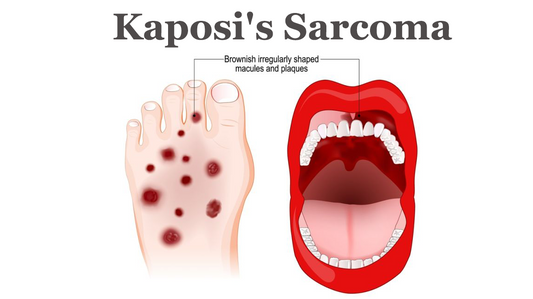 Can Dermatoscope Detect Kaposi's Sarcoma?