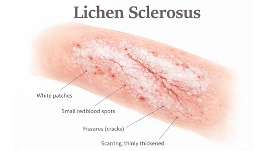 Can Dermatoscope Detect Lichen Sclerosus?