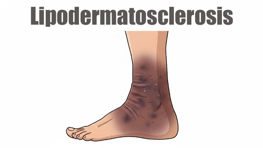 Can Dermatoscope Detect Lipodermatosclerosis?
