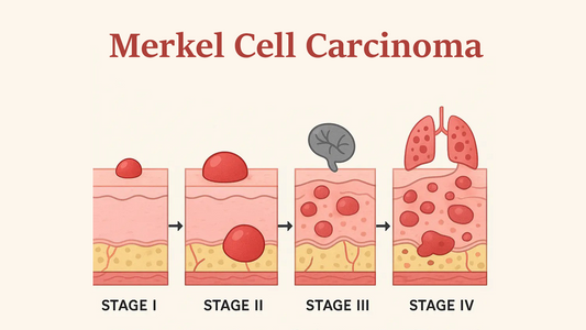 Can Dermatoscope Detect Merkel Cell Carcinoma?
