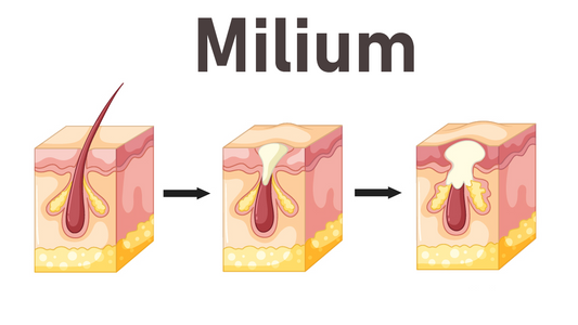 Can Dermatoscope Detect Milium?