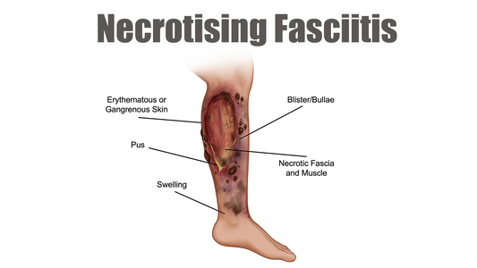 Can Dermatoscope Detect Necrotizing Fasciitis?