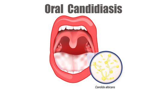 Can Dermatoscope Detect Oral Candidiasis?