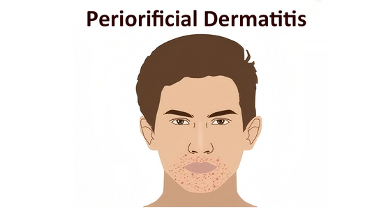 Can Dermatoscope Detect Periorificial Dermatitis?