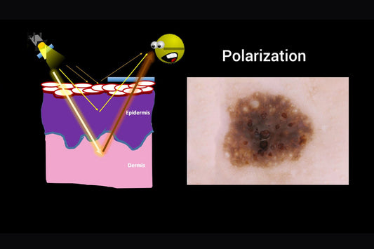 The Most Essential Element of Dermoscopy: Polarized Light - IBOOLO DERMATOSCOPE