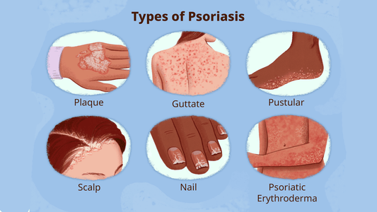 Can Wood's Lamp Detect Psoriasis?