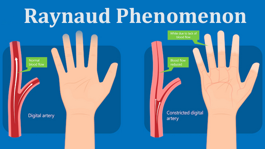Can Dermoscopy Detect Raynaud Phenomenon?