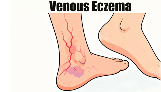 Can Dermatoscope Detect Venous Eczema?