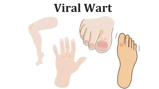 Can Dermatoscope Detect Viral Wart?