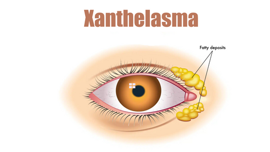 Can Dermatoscope Detect Xanthelasma Palpebrarum?
