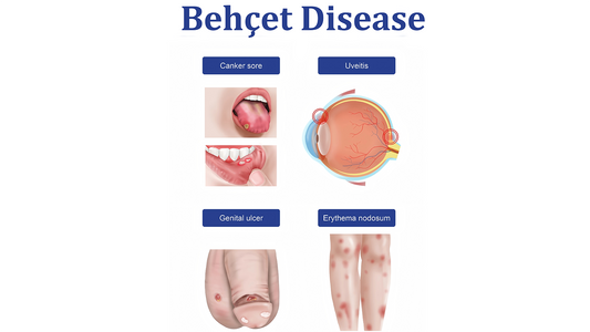 Can Dermatoscope Detect Behçet Disease?