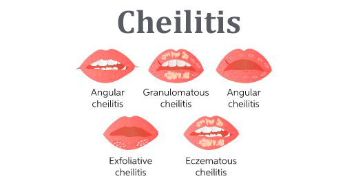 Can Dermatoscope Detect Cheilitis?