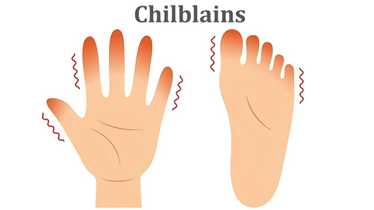 Can Dermatoscope Detect Chilblains?
