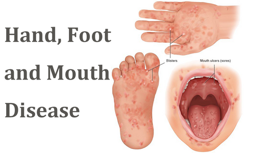 Can a Dermatoscope Detect Hand, Foot and Mouth Disease?