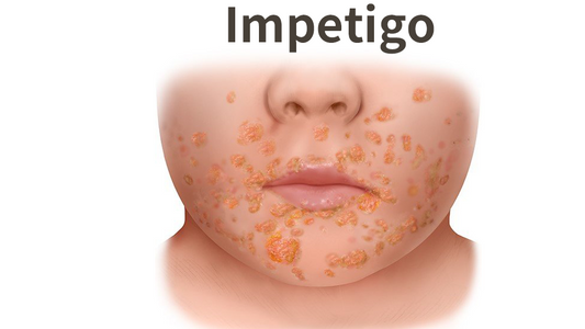 What is Impetigo?