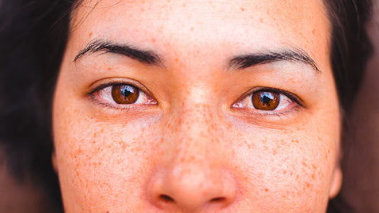 Can Dermatoscope Detect Lentigo?