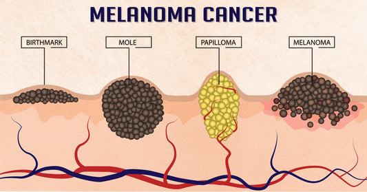 What is the melanoma skin Cancer?