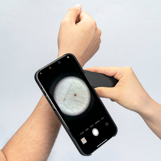 Discover the Power of a Dermatoscope: The Top Uses Revealed - IBOOLO DERMATOSCOPE