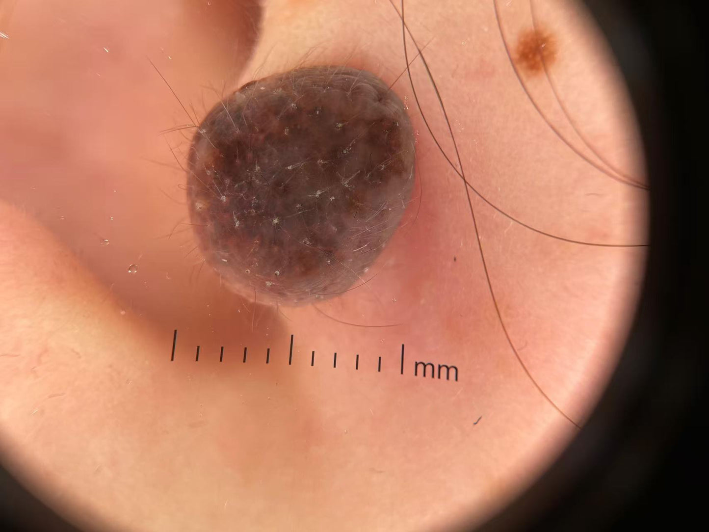 IBOOLO DE-4100 Best Recommendations Handheld Dermatoscope for Dermatologist