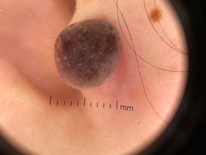 IBOOLO DE-4100 Best Recommendations Handheld Dermatoscope for Dermatologist