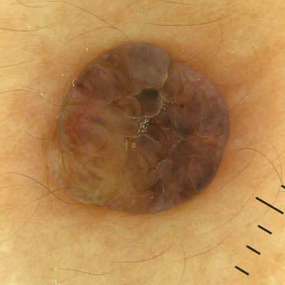 IBOOLO DE-3100 Budget-Friendly Dermatoscope with Smartphone Adapter for Clinic and Telemedicine