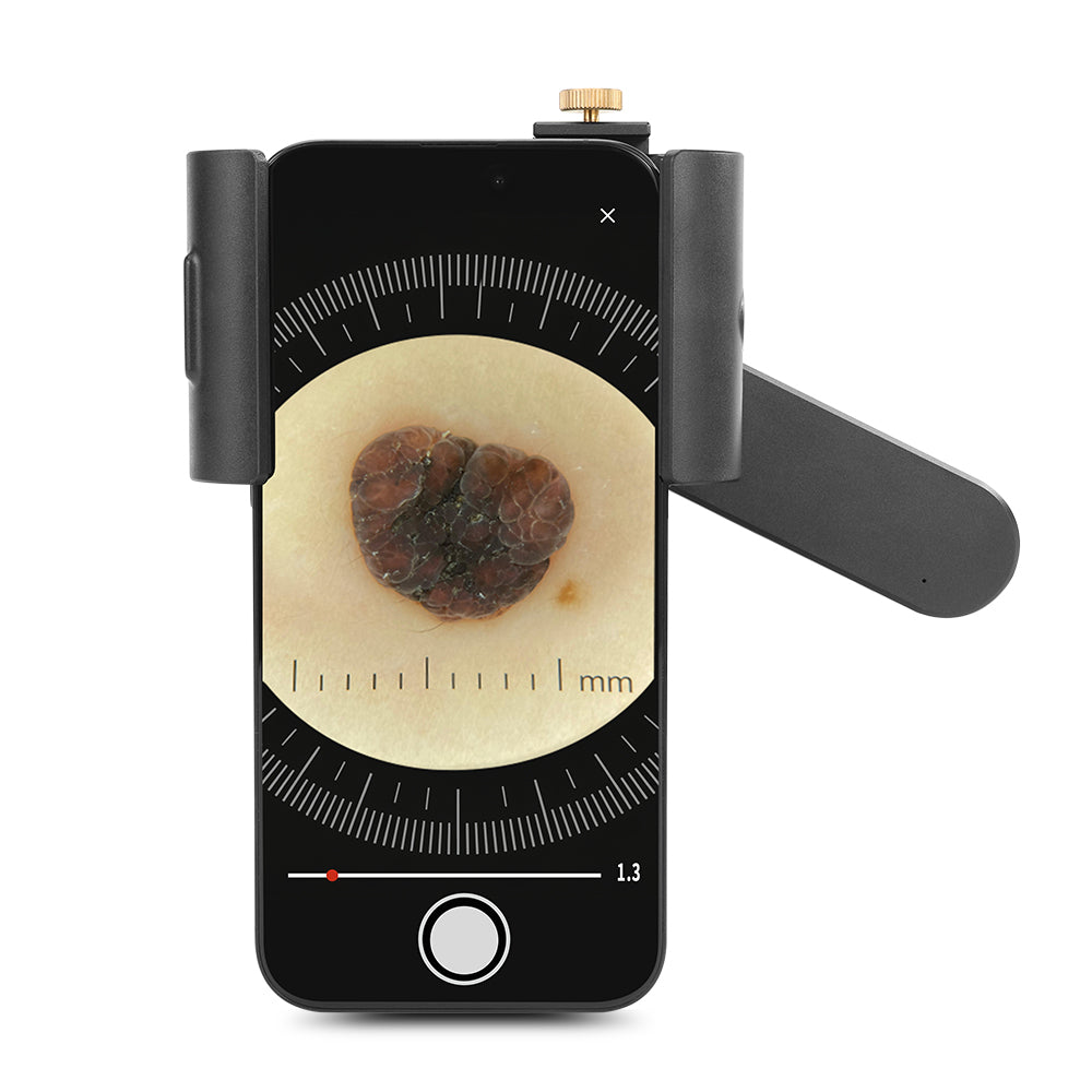 Iboolo Universal 17mm Thread Phone Clamp for DE-3100/3100 PRO Dermatoscope