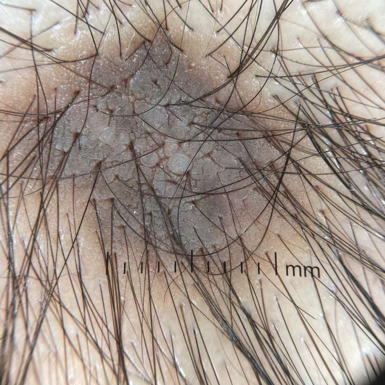 IBOOLO DE-4100 PRO Affordable LED Dermatoscope with Adjustable Brightness for Precise Skin Diagnosis