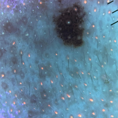 IBOOLO DE-3100 PRO Portable Dermatoscope With Ultraviolet 365nm uv Light