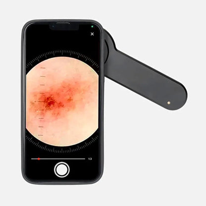 Case for Iphone – Compatible with Dermatoscope